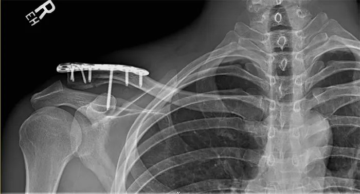 X-ray of the same clavicle after surgery, the fracture fixed with a plate and screws