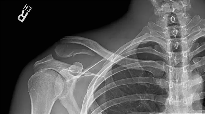 X-ray of a fractured clavicle before surgery, showing the displaced break
